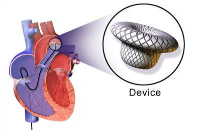 Holter Monitoring