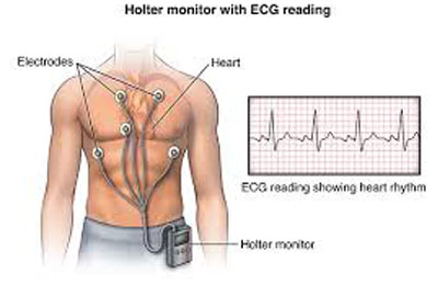 Holter Monitoring