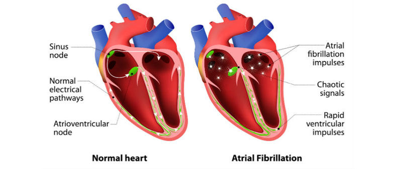 Irregular Heartbeat Treatment in Kolhapur