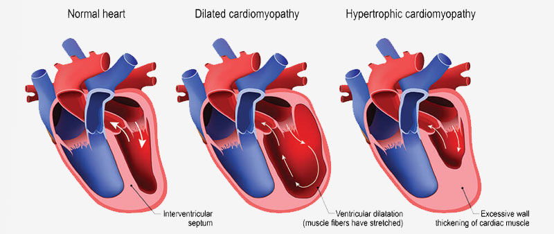 Cardiomyopathy Specialist in Kolhapur