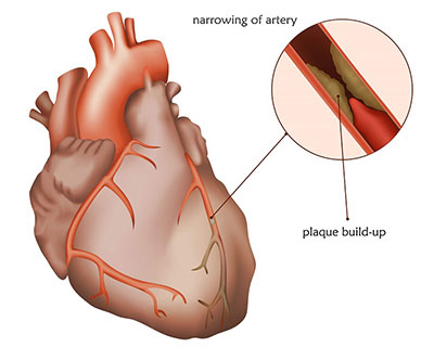 Coronary Artery Disease Symptoms